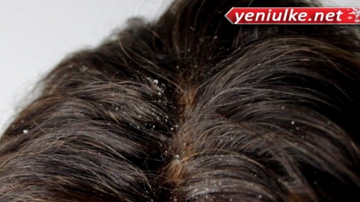 Saç Kepeklenmesi Bir Hastalıkmıdır? Saç Kepeklenmesi Nasıl Tedavi Edilir?