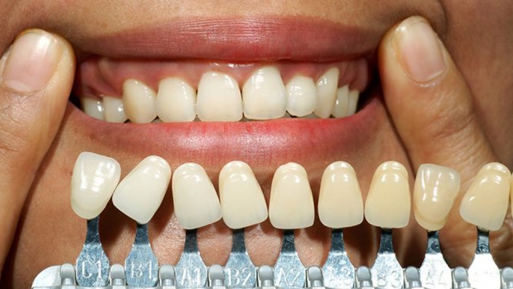 Konya Diş Teli Tedavisi