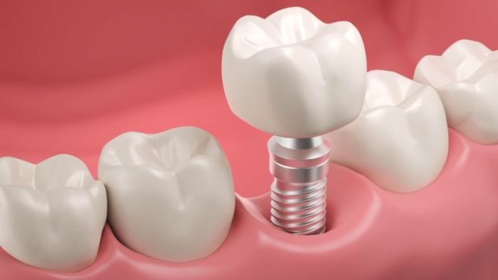 İmplant Tedavisi Ne Kadar Sürer? Tedavi Süreci Nasıldır?